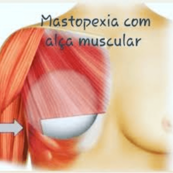 Alca Muscular 2 Alca Muscular 2